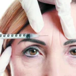 Scientists say Botox could be quietly helping with depression